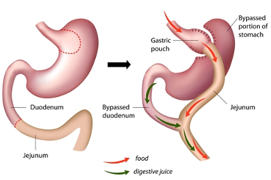 Bypass gastrique réalisé par un chirurgien de l'obésité à Liège et à Bruxelles